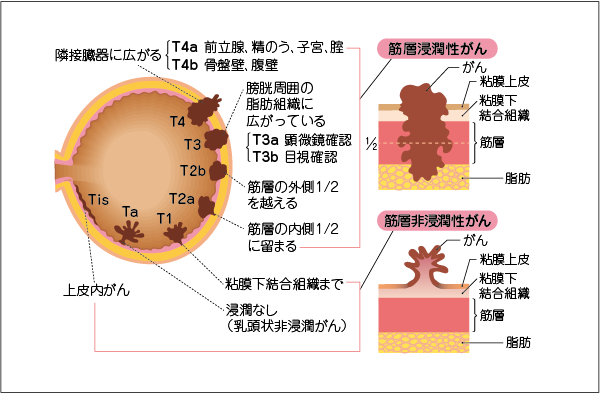 日本膀胱癌治疗有哪些要点，值得收藏！