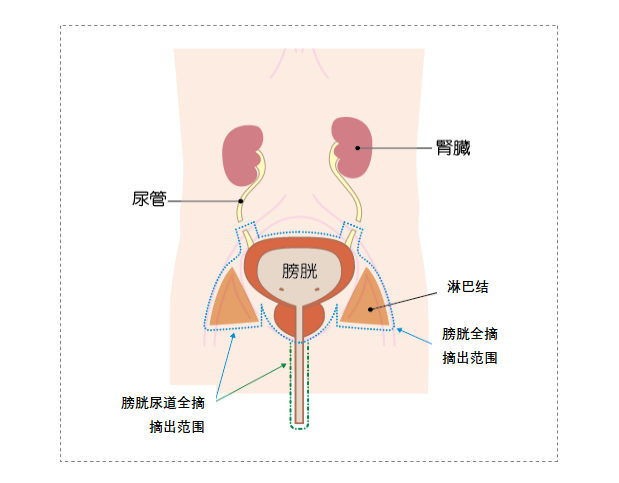 日本膀胱癌治疗有哪些要点，值得收藏！