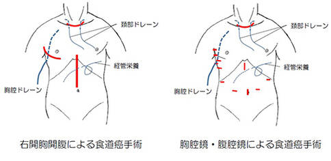 日本如何治疗食道癌？日本食道癌治疗方法