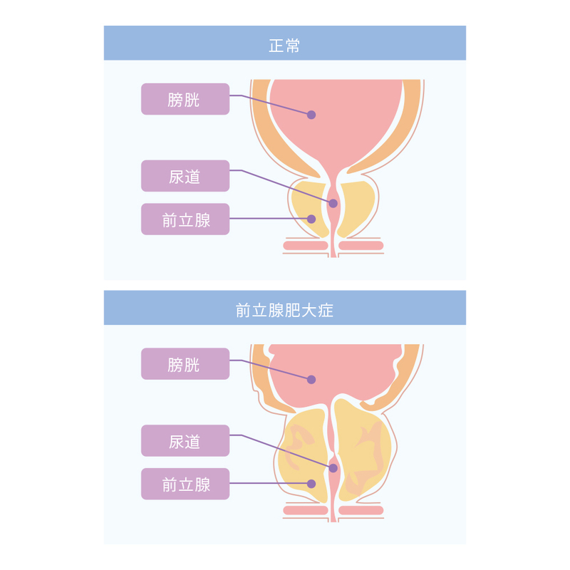 JMT独家 | 关于日本前列腺肥大治疗方法介绍