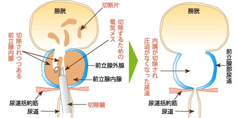 JMT独家 | 关于日本前列腺肥大治疗方法介绍