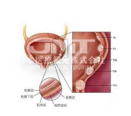 日本治疗膀胱癌：预防及治疗方法介绍