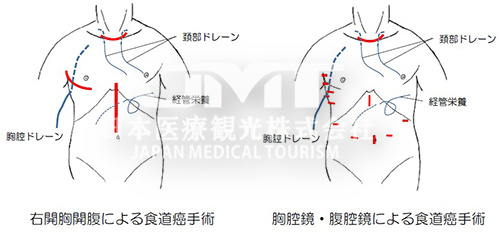 日本看病：日本如何治疗食道癌？