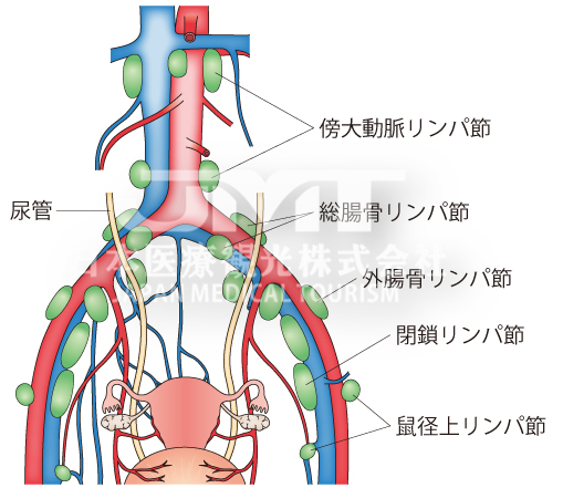 日本看病：卵巢癌治疗日本医院介绍--庆应义塾大学医院