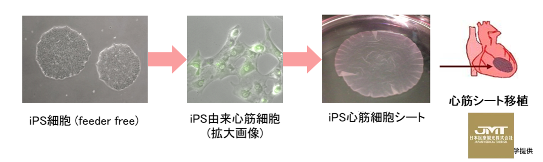 心力衰竭临床试验顺利结束—日本干细胞应用指日可待