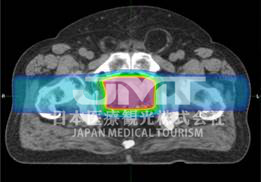 日本国立癌症研究中心东医院质子治疗特点介绍