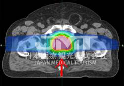 日本国立癌症研究中心东医院质子治疗特点介绍