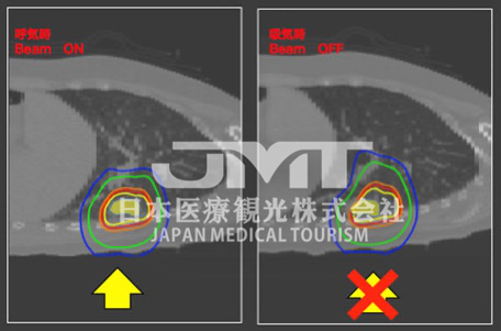 日本国立癌症研究中心东医院质子治疗装置及特点介绍