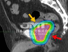 针对前列腺癌日本质子治疗的适应症是哪些？