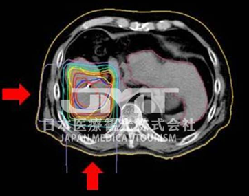 针对肝癌日本质子治疗的适应症有哪些？
