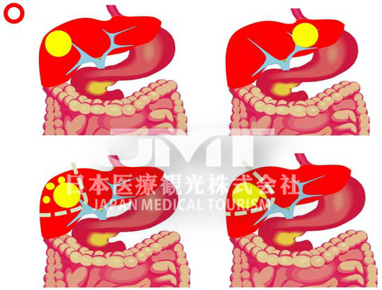 针对肝癌日本质子治疗的适应症有哪些？