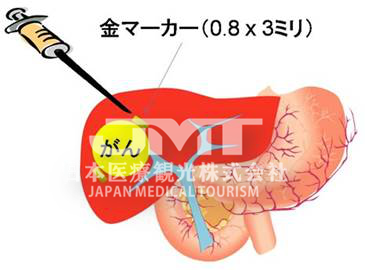 针对肝癌日本质子治疗的适应症有哪些？