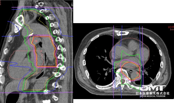 JMT独家 | 日本质子重离子之食道癌的重离子（重粒子）线治疗