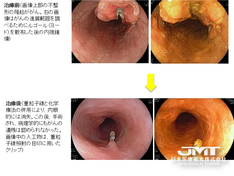 JMT独家 | 日本质子重离子之食道癌的重离子（重粒子）线治疗