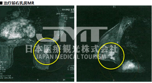 日本针对乳腺癌的免疫细胞治疗方法解析