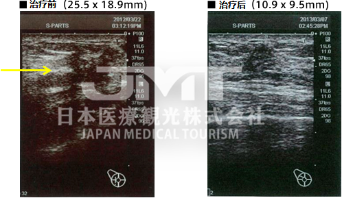 日本针对乳腺癌的免疫细胞治疗方法解析