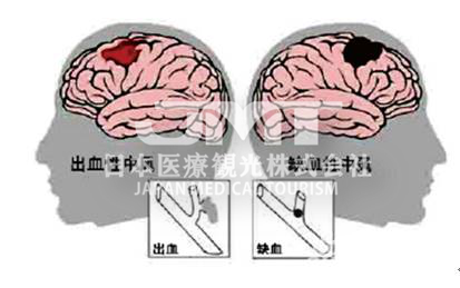 JMT日本看病-一文读懂日本脑出血治疗方法