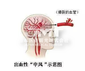 JMT日本看病-一文读懂日本脑出血治疗方法