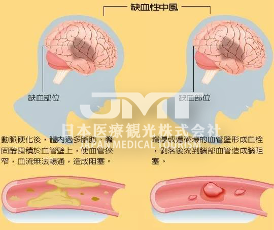 JMT日本看病-一文读懂日本脑出血治疗方法