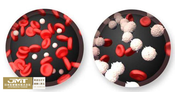 JMT日本癌症治疗-慢性骨髓性白血病的日本治疗方法介绍