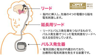 JMT日本看病-世界第三大老年病“杀手”帕金森病日本的治疗怎样？