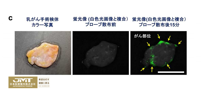 JMT日本尖端医疗-东京大学发现新的乳腺肿瘤特异性生物标记物“MAN2C1”