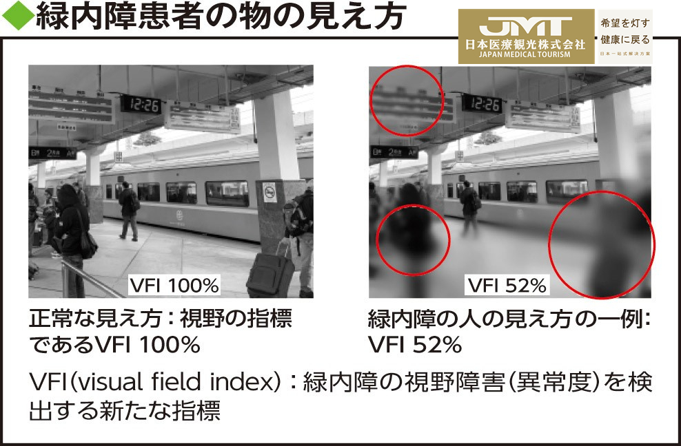 JMT日本慢性病治疗-抑制青光眼的发展可有效避免失明