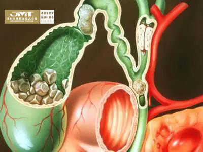 JMT日本癌症治疗-日本胆管癌治疗深度解析