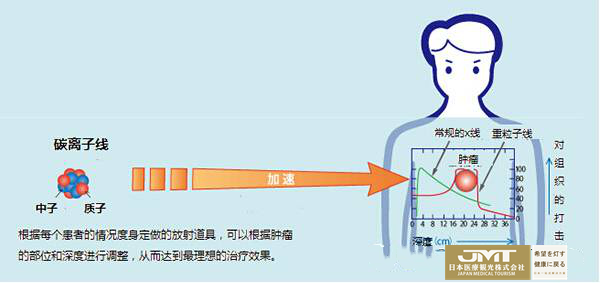 JMT日本重离子治疗-深度剖析日本呼吸系统疾患的重离子疗法