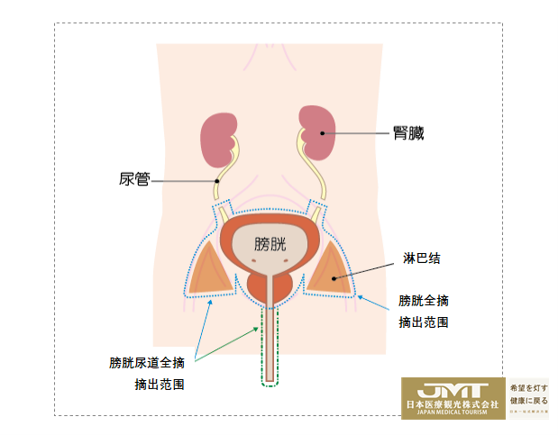 JMT癌症治疗-日本膀胱癌治疗有哪些要点？值得收藏！