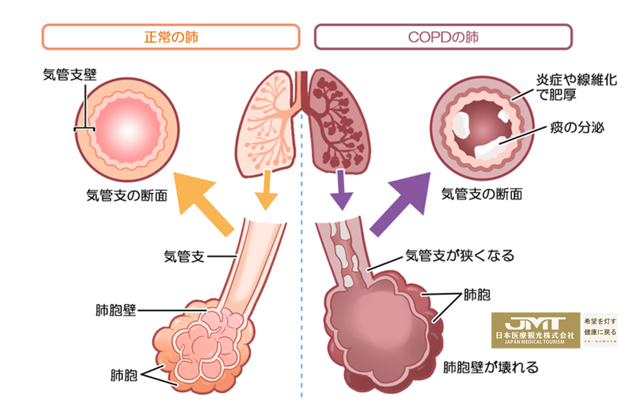 JMT日本尖端医疗-肺部好像长满杂草？这种病日本能否治疗？