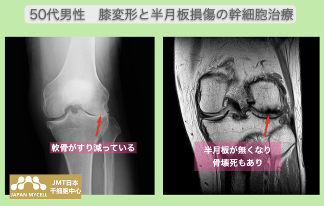 JMT日本干细胞-50多岁男性常年练习空手道，对膝部变形和肩腱板损伤进行干细胞治疗