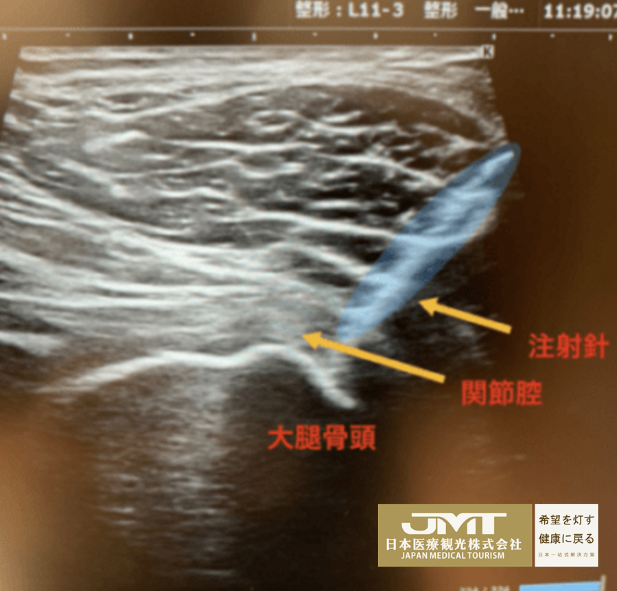 JMT日本干细胞-针对变形性股关节症疼痛的PRP注射