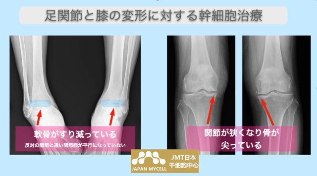 JMT日本干细胞-80多岁女性双膝和右脚关节3处同时进行再生医疗!