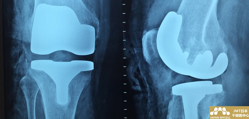 JMT日本干细胞案例-50岁日本男性半月板损伤的干细胞治疗
