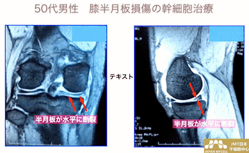 JMT日本干细胞案例-50岁日本男性半月板损伤的干细胞治疗