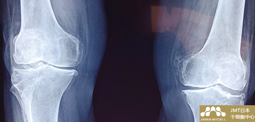 JMT日本干细胞案例-60多岁男性右变形性关节症和半月板损伤的干细胞治疗