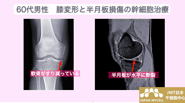 JMT日本干细胞案例-60多岁男性右变形性关节症和半月板损伤的干细胞治疗