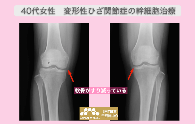 JMT日本干细胞案例-40多岁女性变形性膝关节病的干细胞治疗