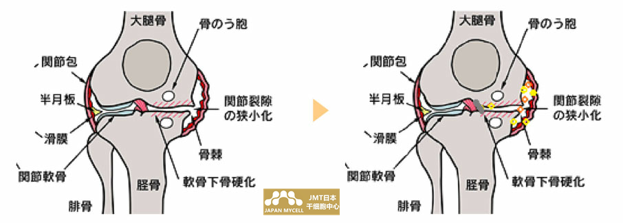 JMT日本干细胞案例-60多岁的男性，患有变形性膝关节病，长年患病