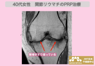 JMT日本干细胞案例-年过40的女性因为类风湿性关节炎膝关节的疼痛迟迟不能缓解