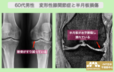 JMT日本干细胞案例-60多岁的男性变形性膝关节症和前交叉韧带断裂的干细胞治疗