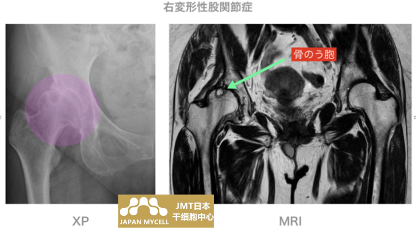 JMT日本干细胞案例-针对50多岁女性右股关节病变进行干细胞治疗