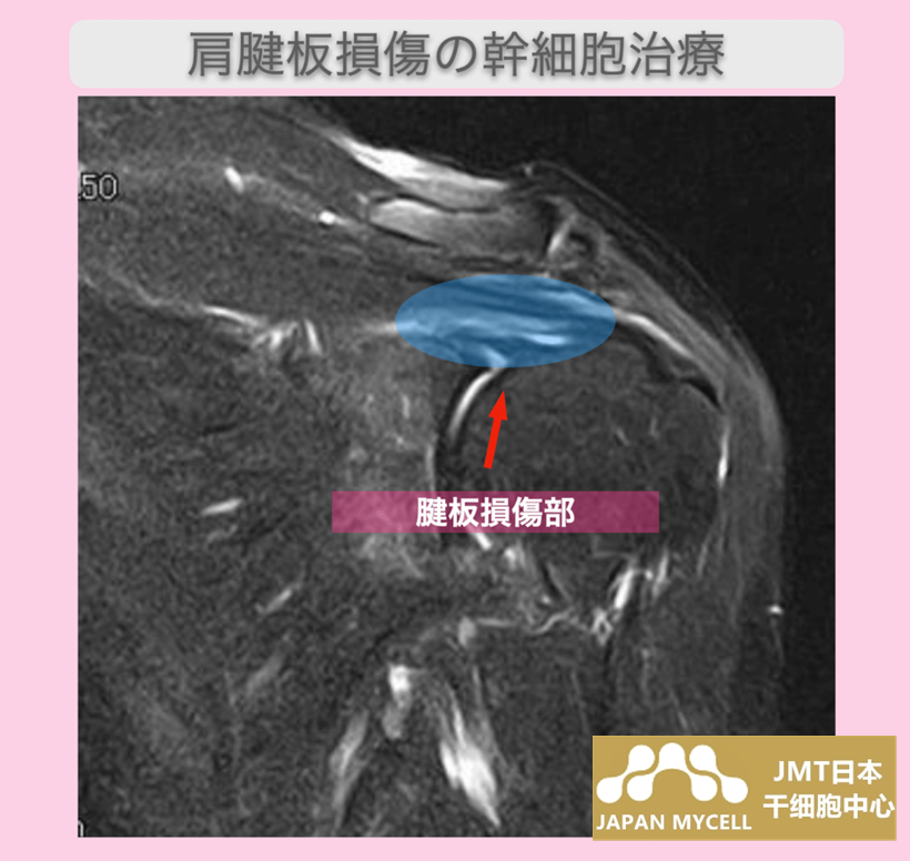 日本干细胞案例-60多岁日本女性肩袖损伤的混合操作和干细胞治疗