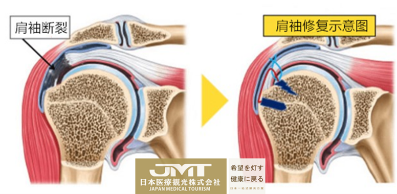 JMT日本干细胞-针对肩部疼痛的日本干细胞治疗