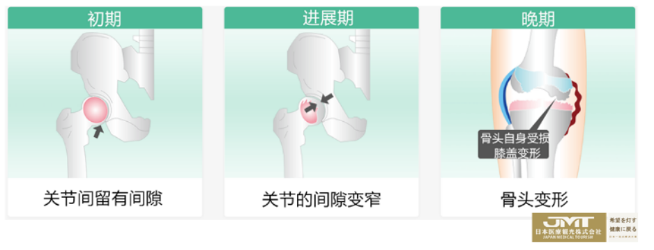 JMT日本干细胞-变形性髋关节症的日本干细胞治疗