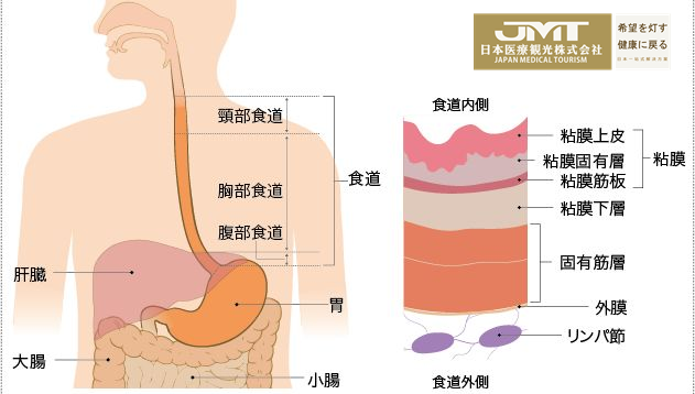 JMT日本癌症治疗-日本临床认证批准opdivo用于治疗食道癌有效