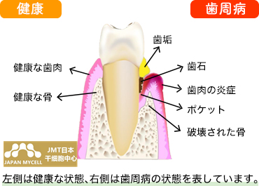 JMT日本干细胞治疗牙周病-牙周病是什么？