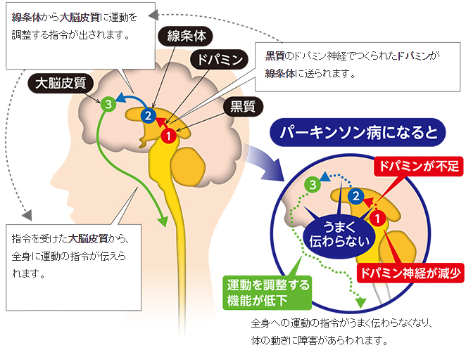 JMT日本干细胞治疗帕金森-帕金森病的症状、诊断、和治疗