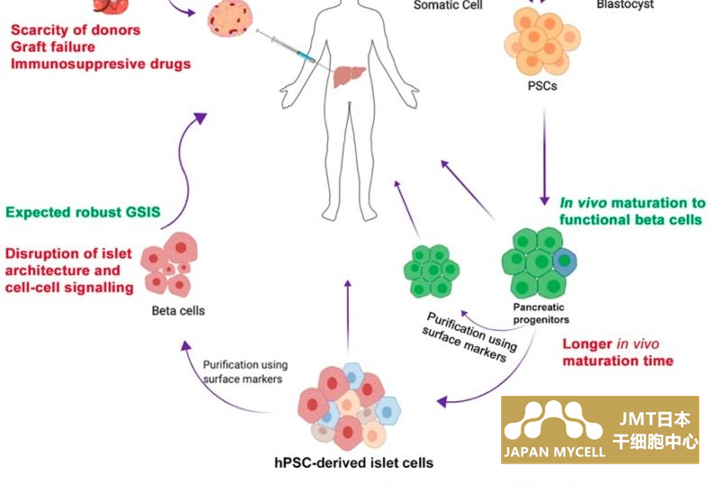 JMT日本干细胞-日本干细胞治疗糖尿病